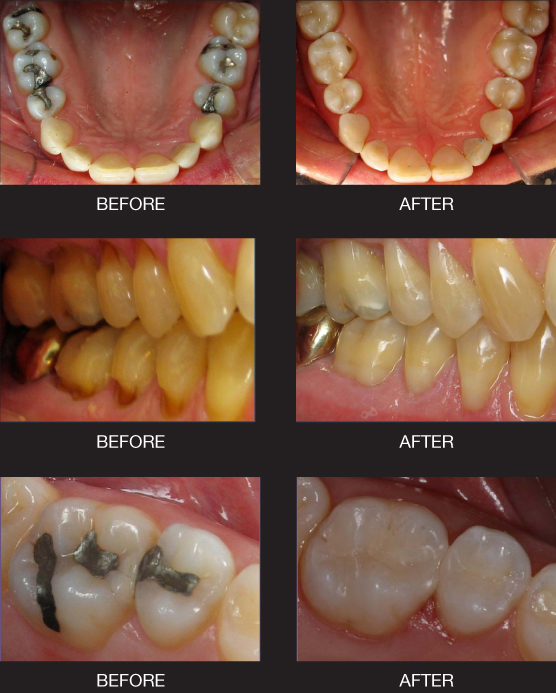 Before and After Composite Fillings